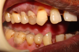 Teeth showing cuts, caries and tooth-colored fillings
